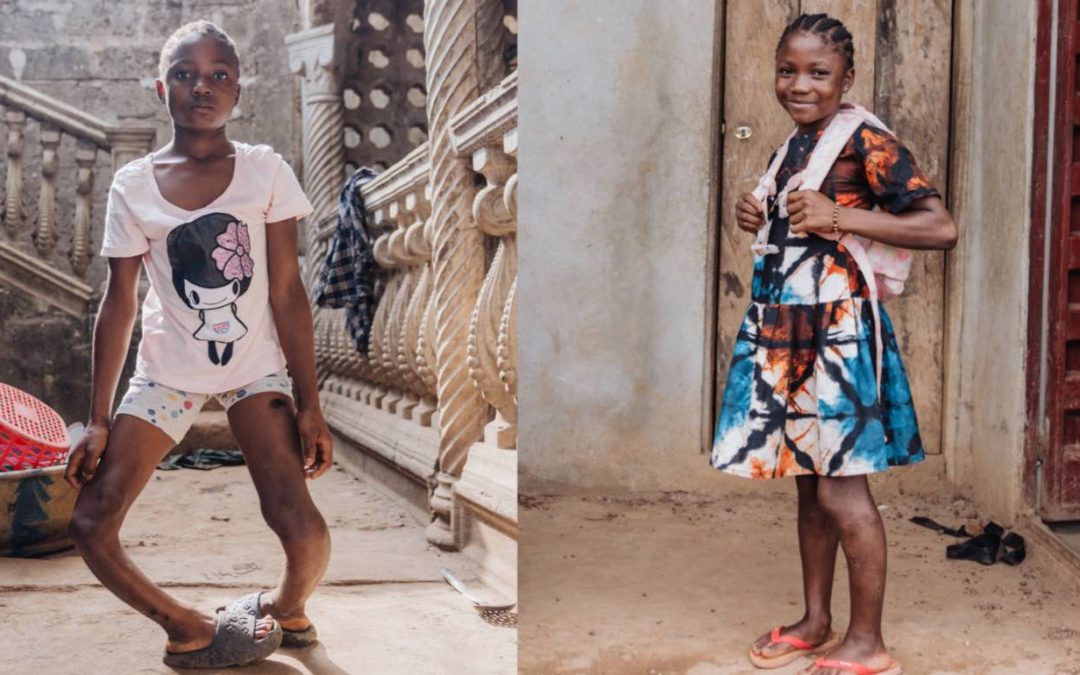 Schoolgirl With Severely Bowed Legs Gets Life-Changing Surgery to Straighten Them–And is Now 5 Inches Taller